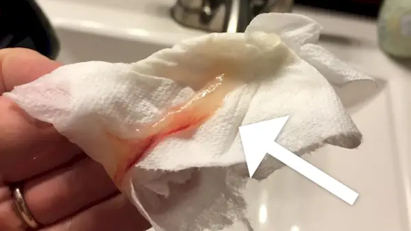 Bouchon muqueux : le travail commence-t-il lorsque vous le perdez ? (Photos)